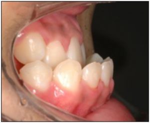ชี้แจงปัญหาเรื่อง การสบฟันลักษณะที่มีฟันล่างครอบฟันบน เพิ่มเติม