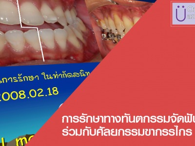 การรักษาทางทันตกรรมจัดฟัน ร่วมกับศัลยกรรมขากรรไกร