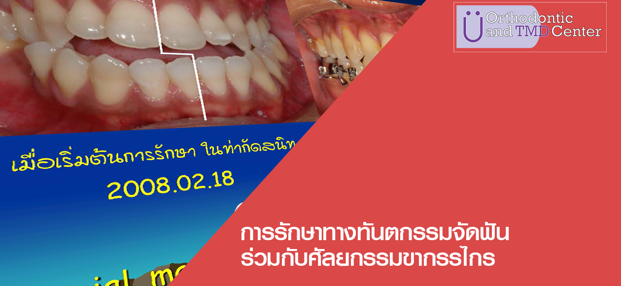 การรักษาทางทันตกรรมจัดฟัน ร่วมกับศัลยกรรมขากรรไกร
