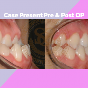 Case Present Pre & Post OP