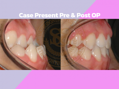 Case Present Pre & Post OP