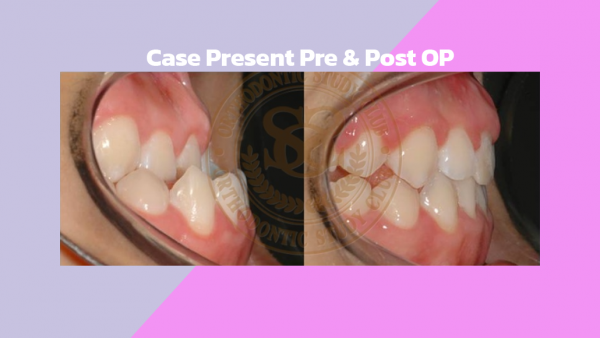 Case Present Pre & Post OP