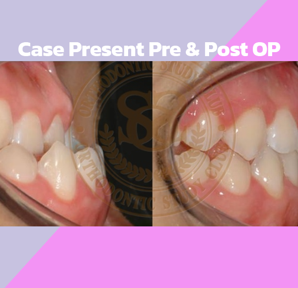 Case Present Pre & Post OP