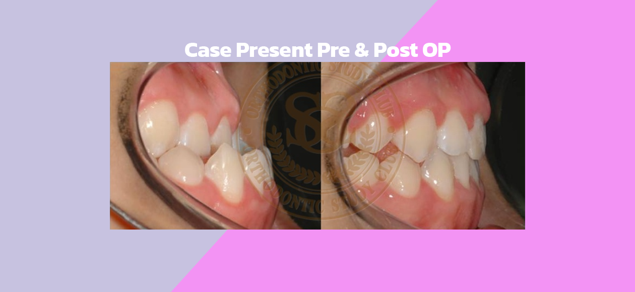 Case Present Pre & Post OP