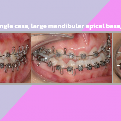 Class III high angle case, large mandibular apical base, 2 Jaw Surgery