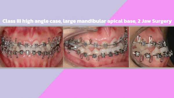 Class III high angle case, large mandibular apical base, 2 Jaw Surgery