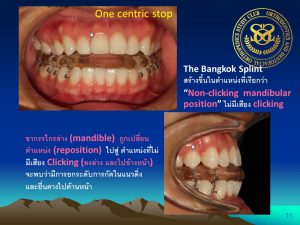11 The Bangkok Splint