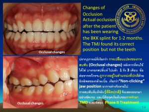 14 The Bangkok Splint
